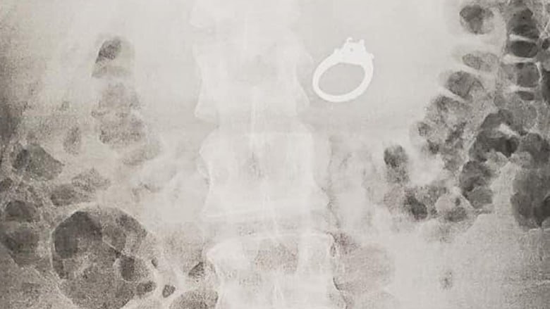 Woman swallows engagement ring in her sleep