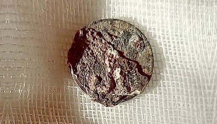 Coin mistakenly stuck in nose surgically removed after five decades