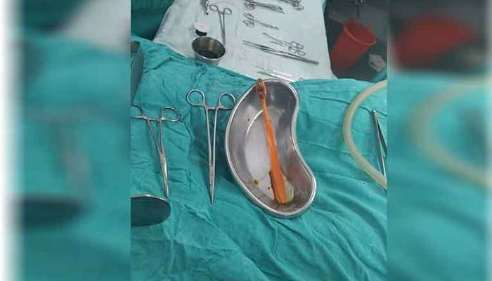 Surgeon removes 9-inch toothbrush from patient’s stomach