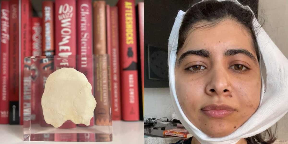 Malala remembers how she is still recovering from one Taliban bullet nine years later