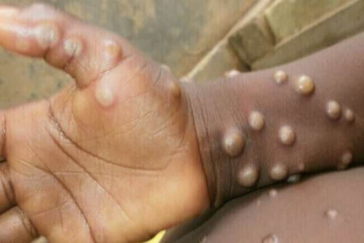 WHO declares global health emergency over monkeypox outbreak