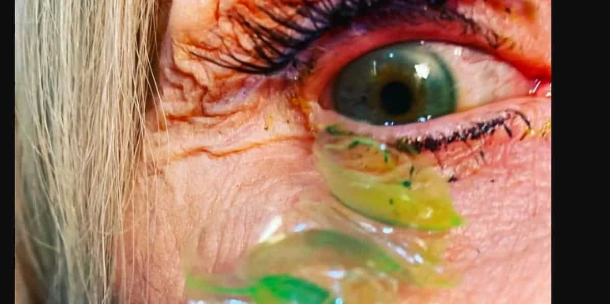 Video: Doctor removes 23 contact lenses from patient’s eye